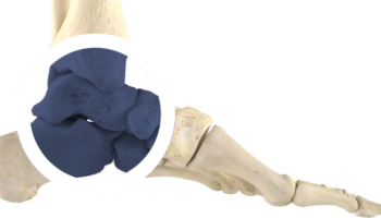 Ankle_Charcot Ankle_Charcot