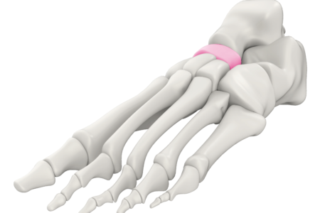 Pilon Fractures Pilon Fractures